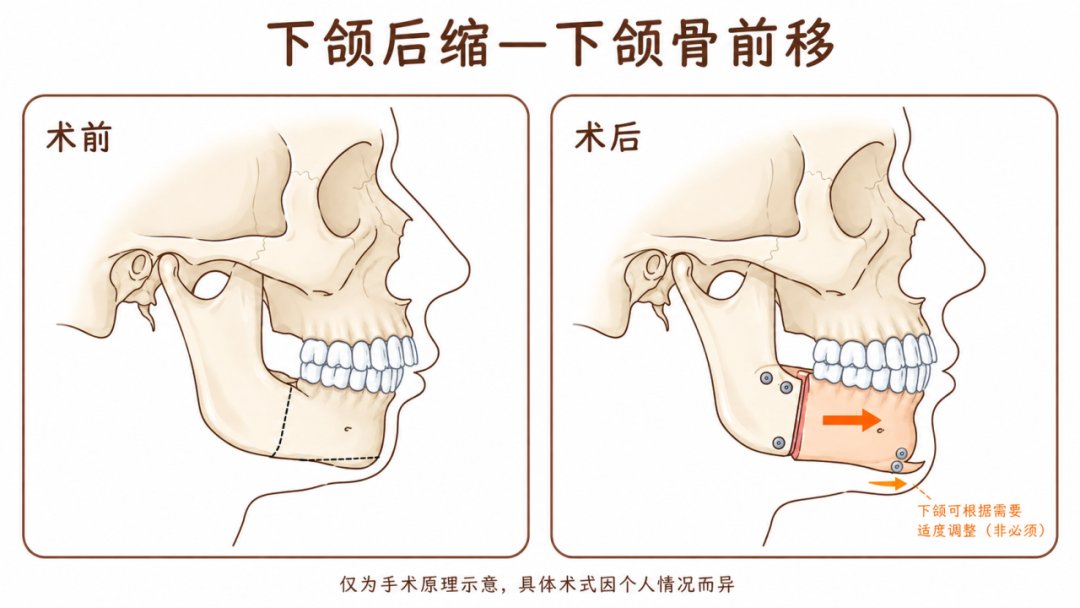 听说拔智齿、做正畸能瘦脸?真有人脸直接小一圈?