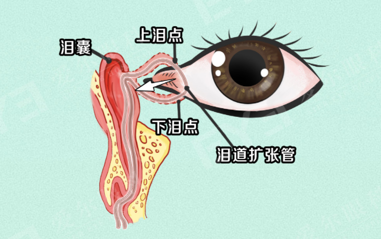 莫名流泪反反复复,拖久了可引发炎症!泪道问题要早查