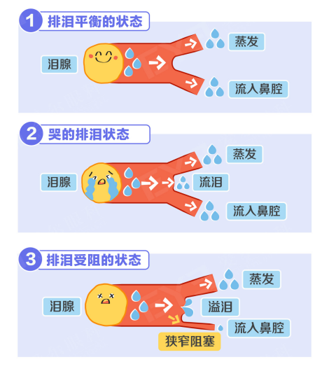 莫名流泪反反复复,拖久了可引发炎症!泪道问题要早查