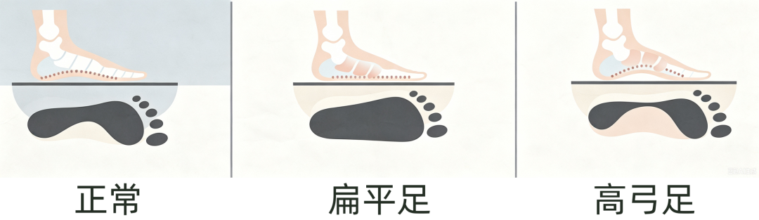 儿童足部筛查:高原娃的小脚更需要科学养护