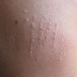 皮肤上长小疙瘩？别慌张，也别乱抠！一文说清HPV感染后的常见皮肤疣