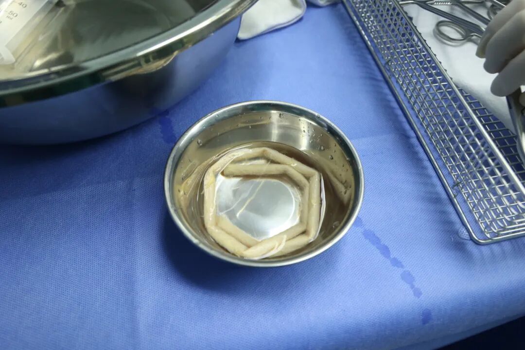瑞金海南医院应用生物人工血管，为胰腺恶性肿瘤患者闯过 “血管难关”