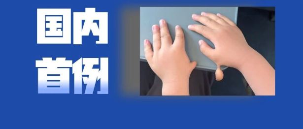 跨越千里的生命托付｜【国内首例】自体漂浮多指移植，为男童再造拇指