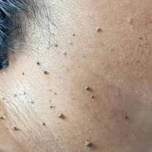皮肤上长小疙瘩？别慌张，也别乱抠！一文说清HPV感染后的常见皮肤疣
