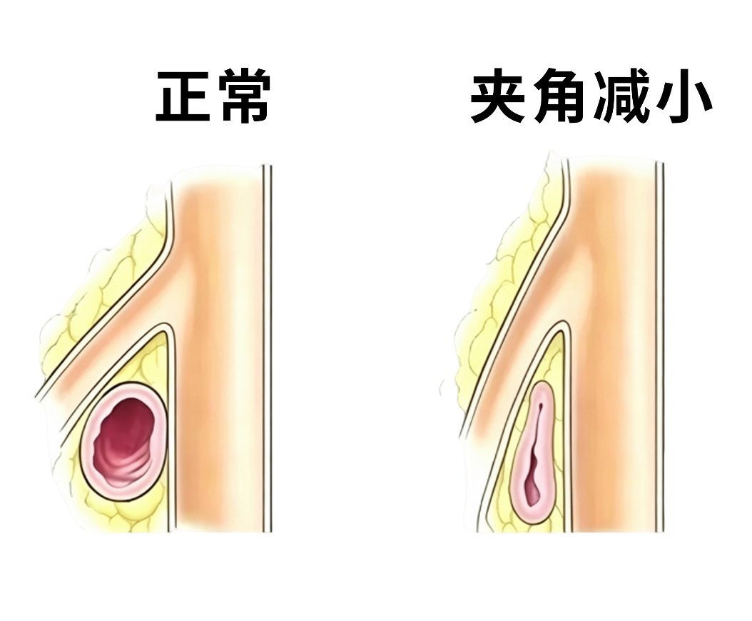 14岁少女餐后腹痛5年！我院胃肠外科精准诊疗罕见复合型血管压迫病症
