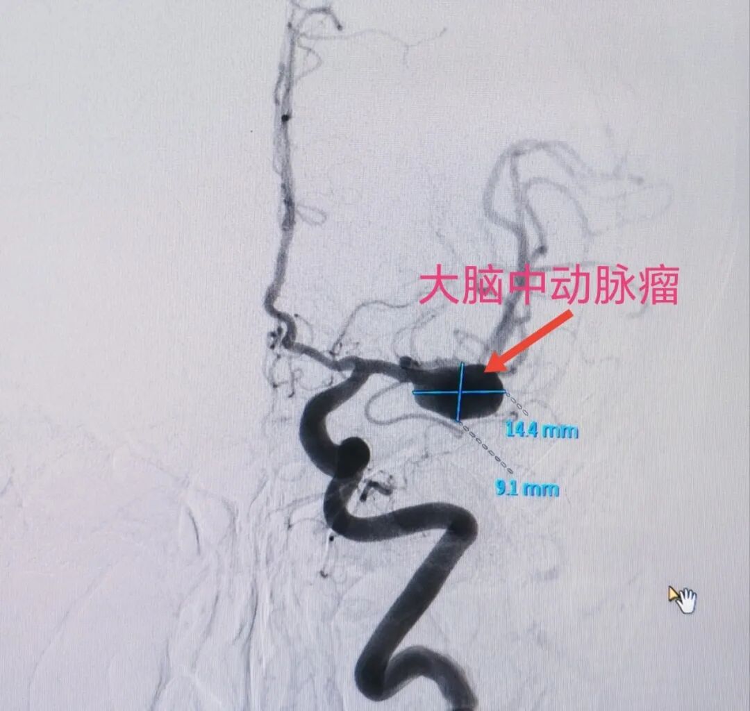 一天三台高难度脑科手术：南京江北医院神经诊疗中心团队的「极限挑战」与「生命守护」