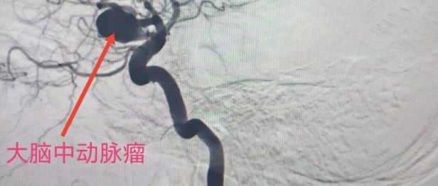 一天三台高难度脑科手术：南京江北医院神经诊疗中心团队的「极限挑战」与「生命守护」