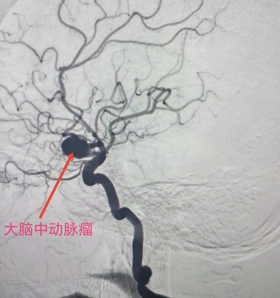 一天三台高难度脑科手术：南京江北医院神经诊疗中心团队的「极限挑战」与「生命守护」