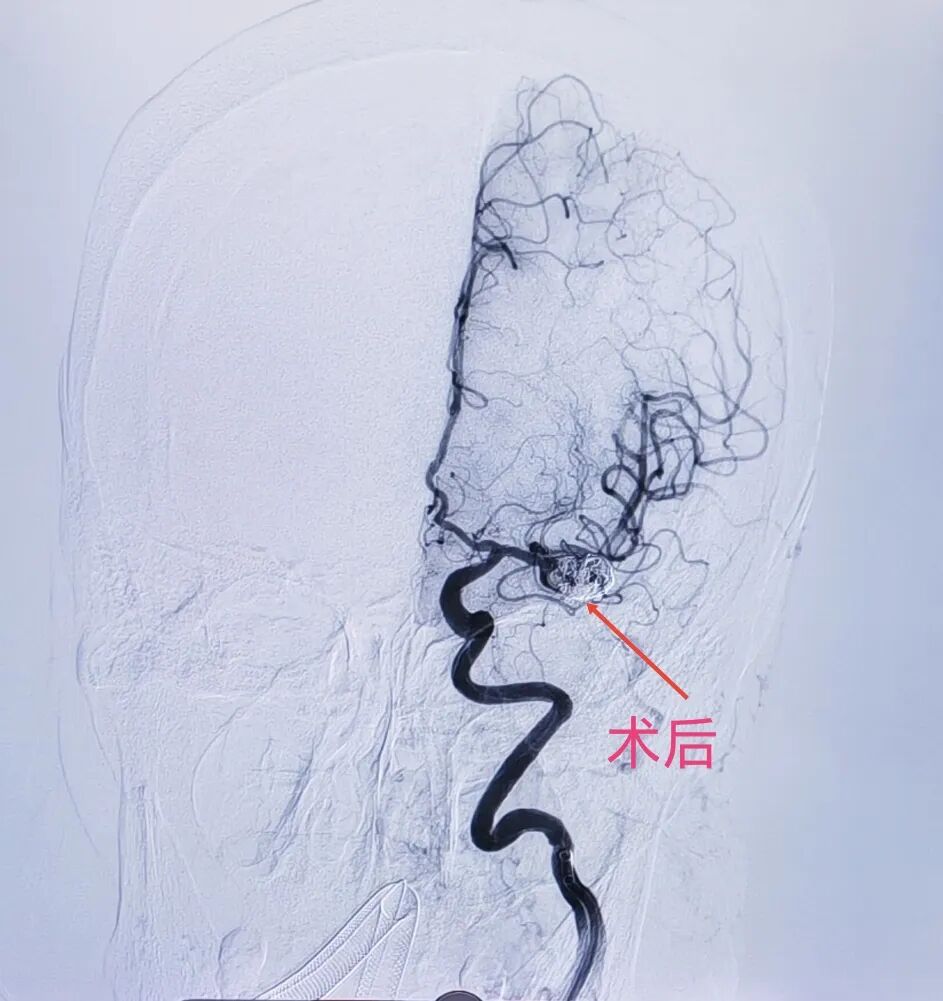 一天三台高难度脑科手术：南京江北医院神经诊疗中心团队的「极限挑战」与「生命守护」