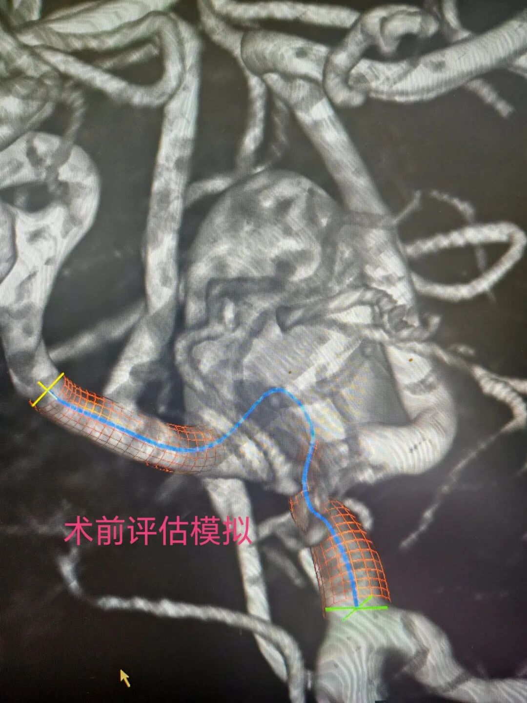 一天三台高难度脑科手术：南京江北医院神经诊疗中心团队的「极限挑战」与「生命守护」