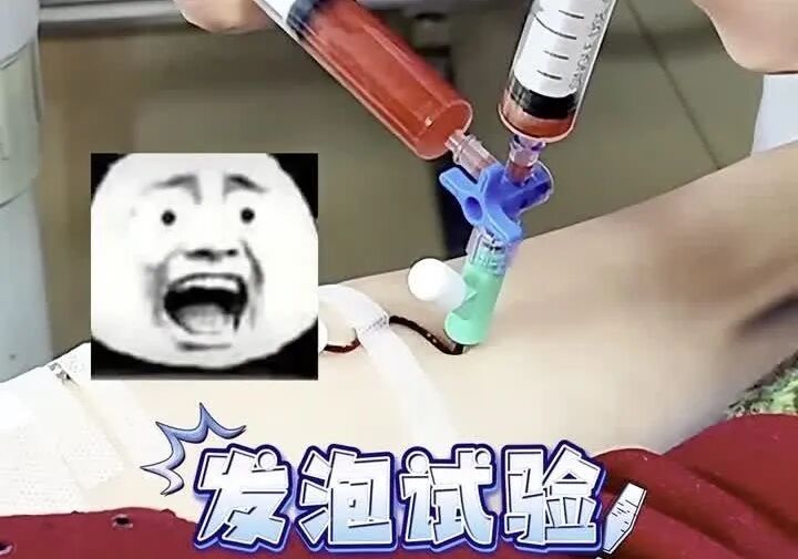 南京鼓楼医院集团宿迁医院心血管内科成功开展首例可降解卵圆孔未闭封堵器植入术