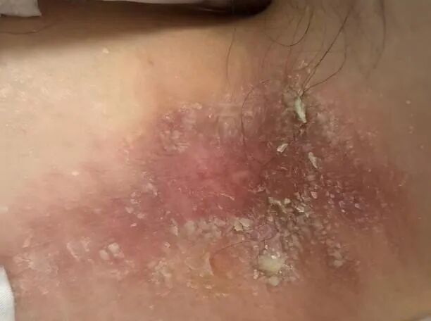 隐翅虫落在身上，千万别拍！正确做法看这里