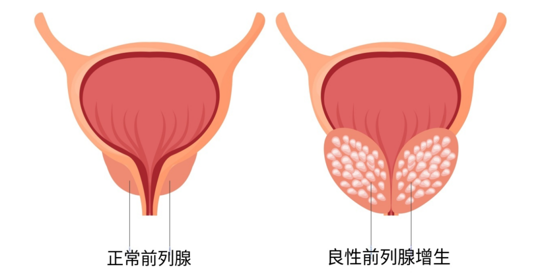 前列腺增生|中老年男性高发问题!读懂筛查、分级治疗,告别排尿困扰