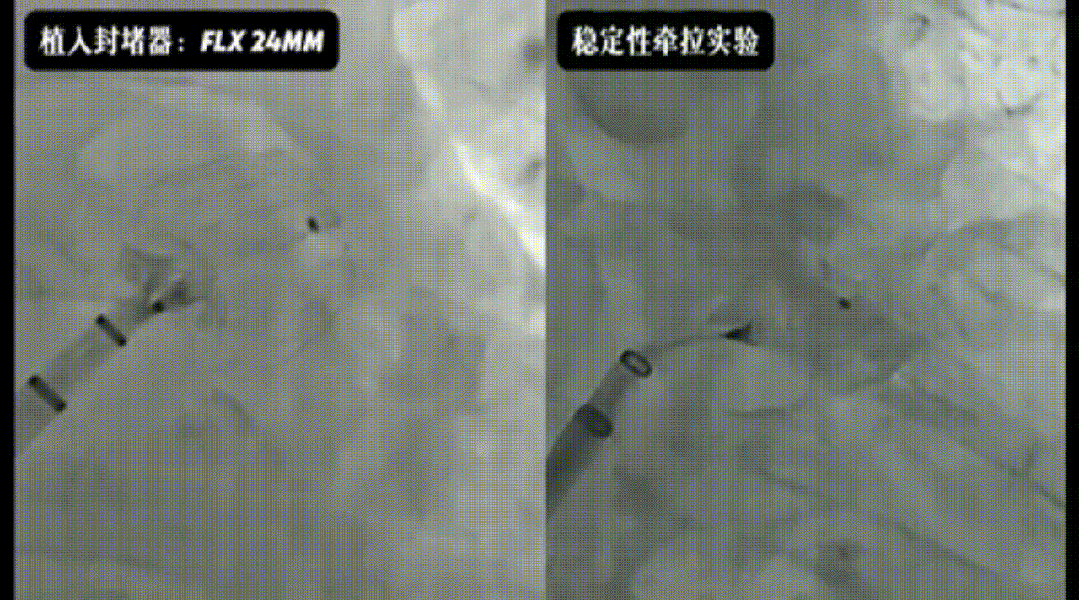 三维导航 脉冲精准消颤 一站式封堵 中西合璧护心——西安市中医医院完成三维指导下脉冲消融联合左心耳封堵一站式手术