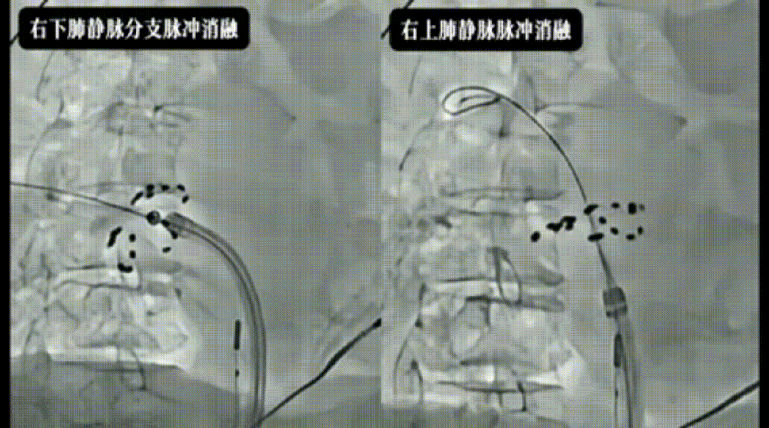 三维导航 脉冲精准消颤 一站式封堵 中西合璧护心——西安市中医医院完成三维指导下脉冲消融联合左心耳封堵一站式手术