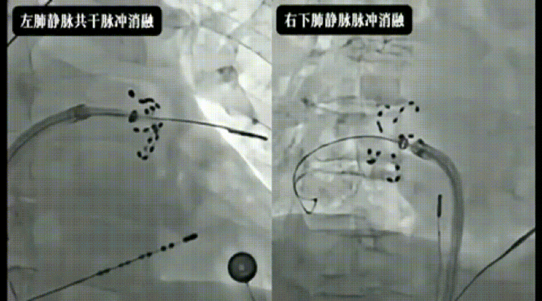 三维导航 脉冲精准消颤 一站式封堵 中西合璧护心——西安市中医医院完成三维指导下脉冲消融联合左心耳封堵一站式手术