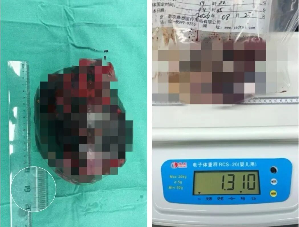 腹痛背后的“时间炸弹”——卵巢畸胎瘤蒂扭转