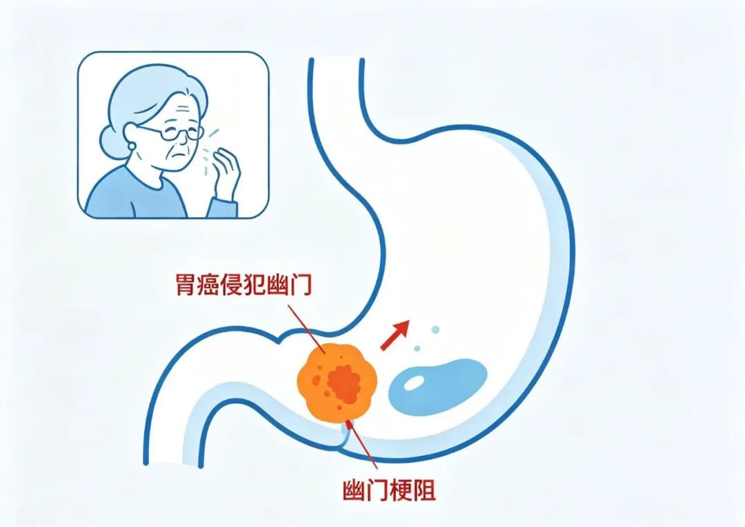 从"被判放弃"到自主进食——苏州明基医院胃肠外科团队:高龄不是手术禁区,精准微创可以破局