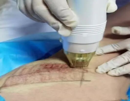 【健康科普】入秋了,腋臭还在?别让它继续困住你