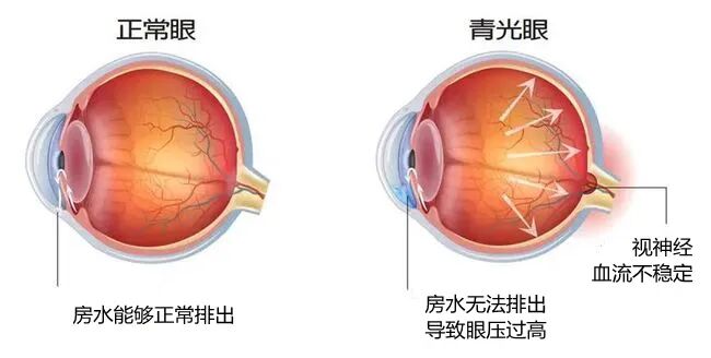 脾气不好,真的能把眼睛“气炸”?