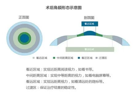 普瑞专家说|40岁还能做屈光手术吗?别让年龄困住清晰视界