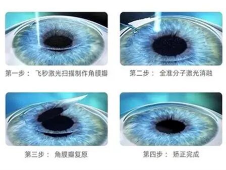 普瑞专家说|40岁还能做屈光手术吗?别让年龄困住清晰视界