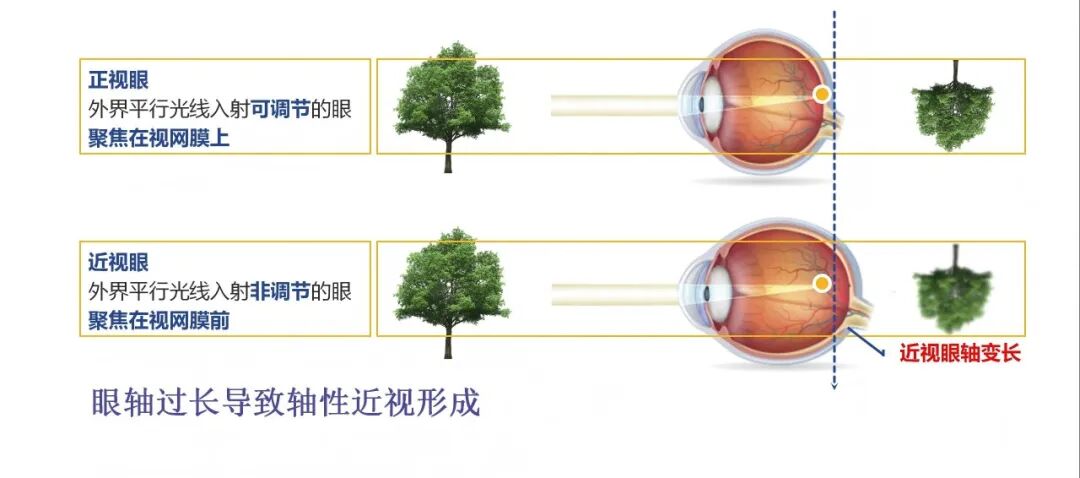 普瑞专家说|近视与眼轴:眼球“变长”背后的真相