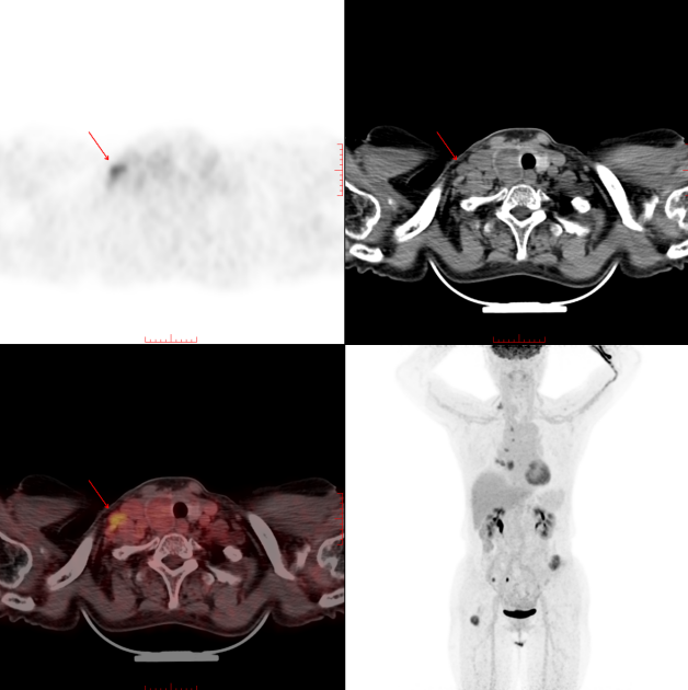 PET/CT vs 增强 CT,肿瘤检查该怎么选?一文看懂区别