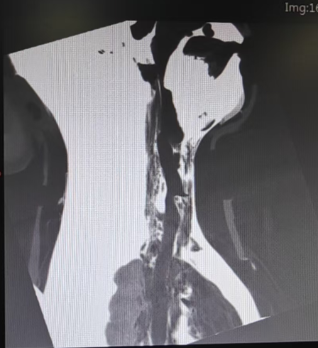同样是电动车事故，一顶头盔为何隔开了两种结局？