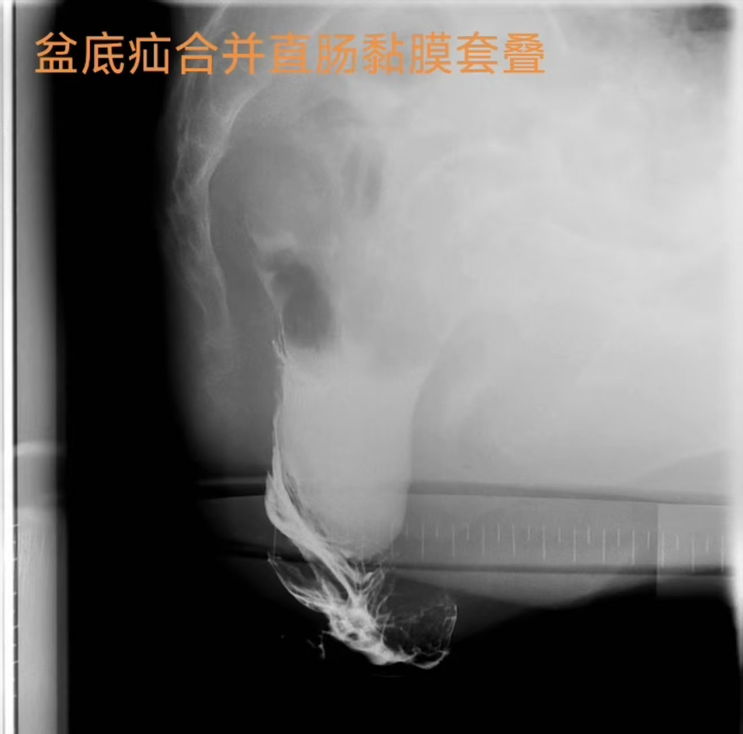 10 年便秘,病根竟在盆底?我院成功完成一例经腹盆底悬吊术