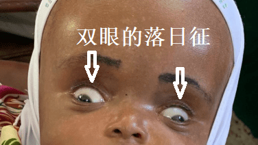 量一下孩子头围，出现这种情况要注意！
