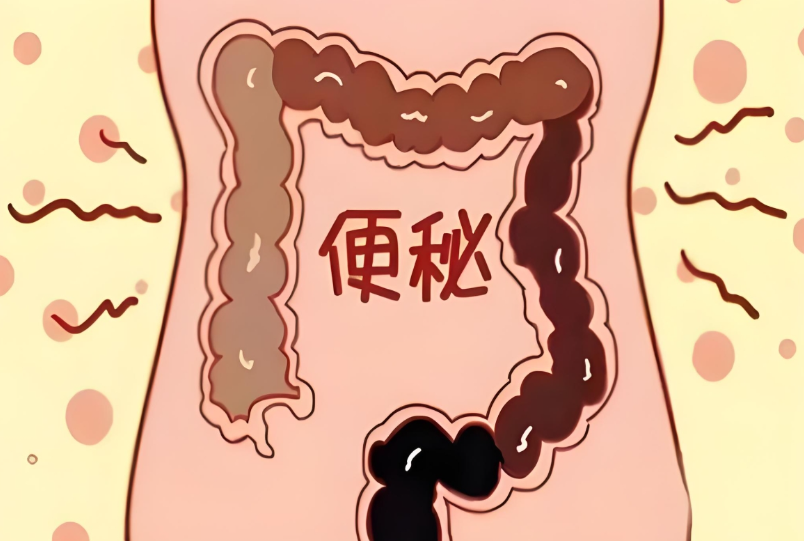 10 年便秘,病根竟在盆底?我院成功完成一例经腹盆底悬吊术