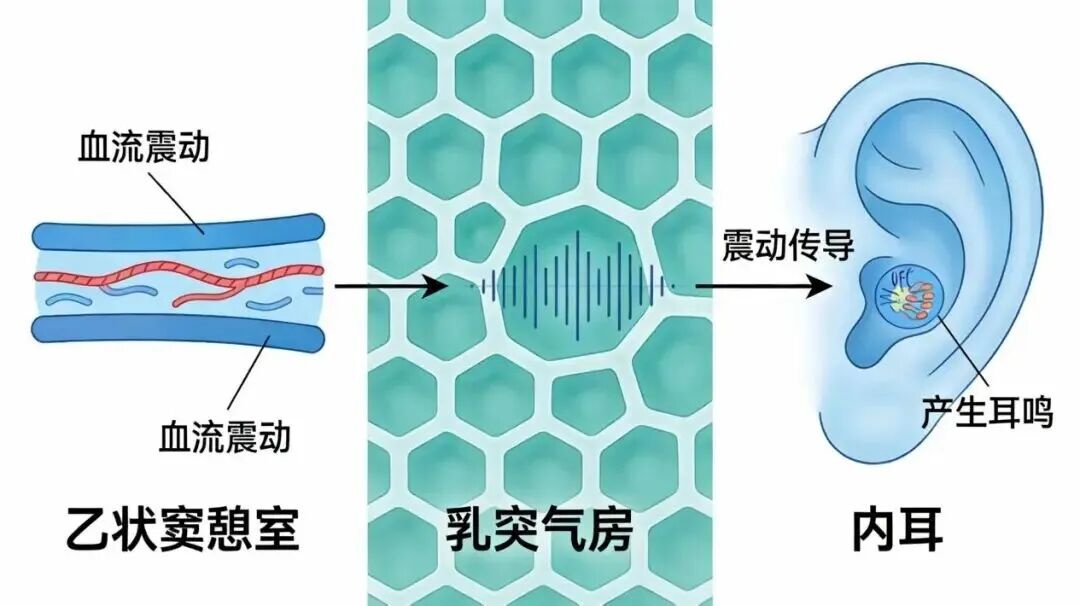 耳朵总是听见奇怪的“心跳声”——淮安市一院耳鼻喉科金新主任成功开展乙状窦憩室封闭术