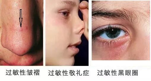 【健康科普】你们家娃会不会总流鼻涕、打喷嚏？