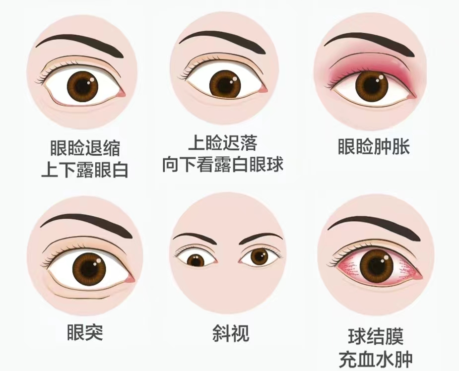 甲状腺眼病——大眼睛的“烦恼”