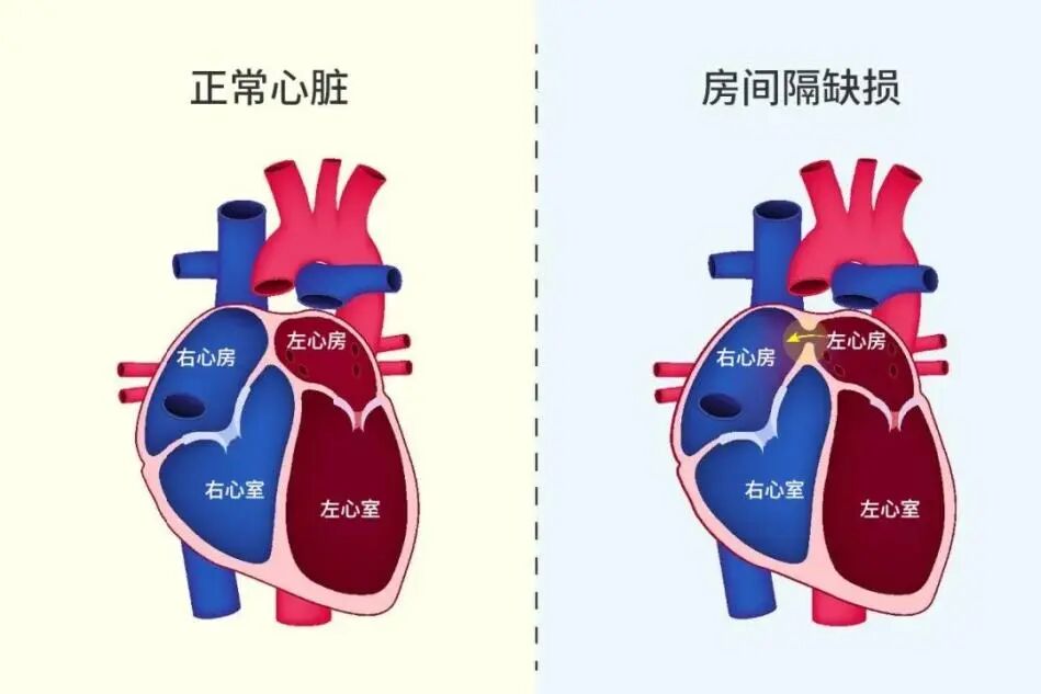 超声检查却意外发现心脏里多了个“洞”,是怎么回事?你了解房间隔缺损吗?