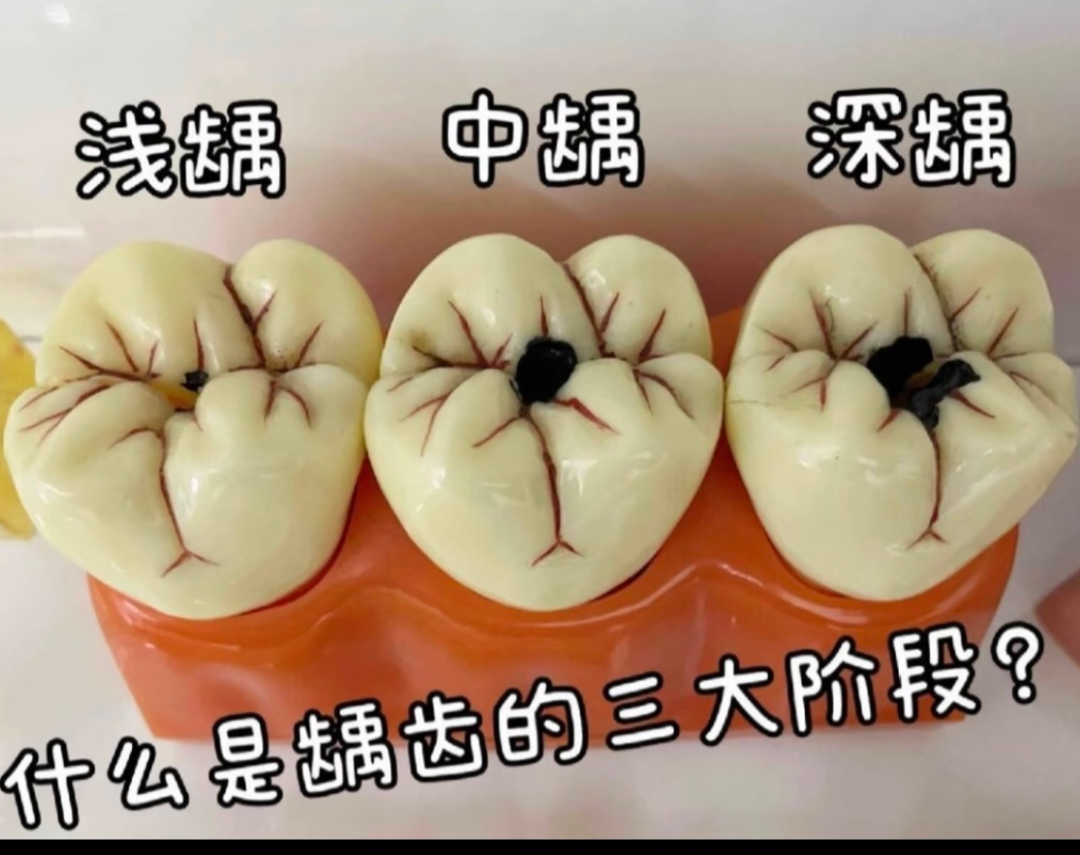 天天刷牙,为什么还蛀牙?因为你没搞懂这件事