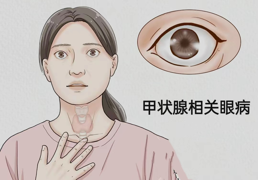 甲状腺眼病——大眼睛的“烦恼”