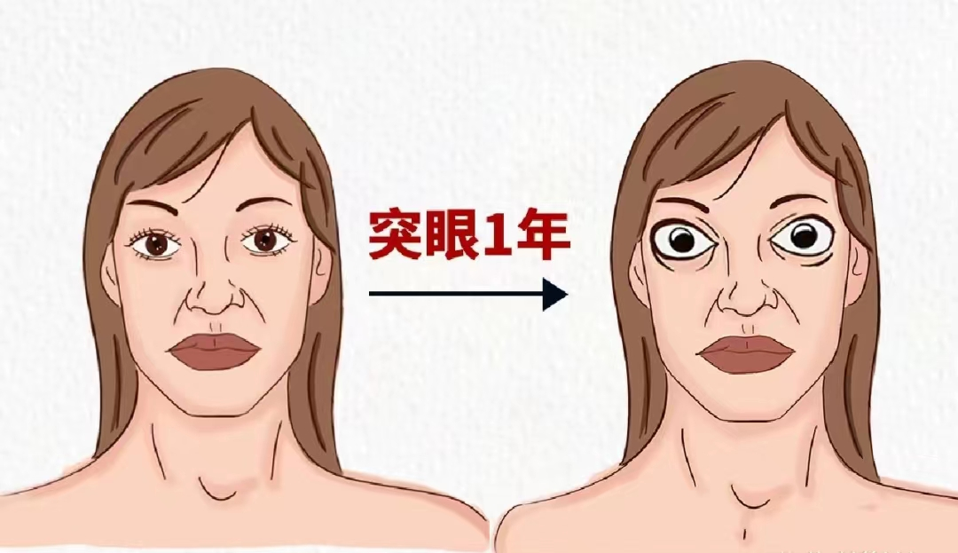 甲状腺眼病——大眼睛的“烦恼”