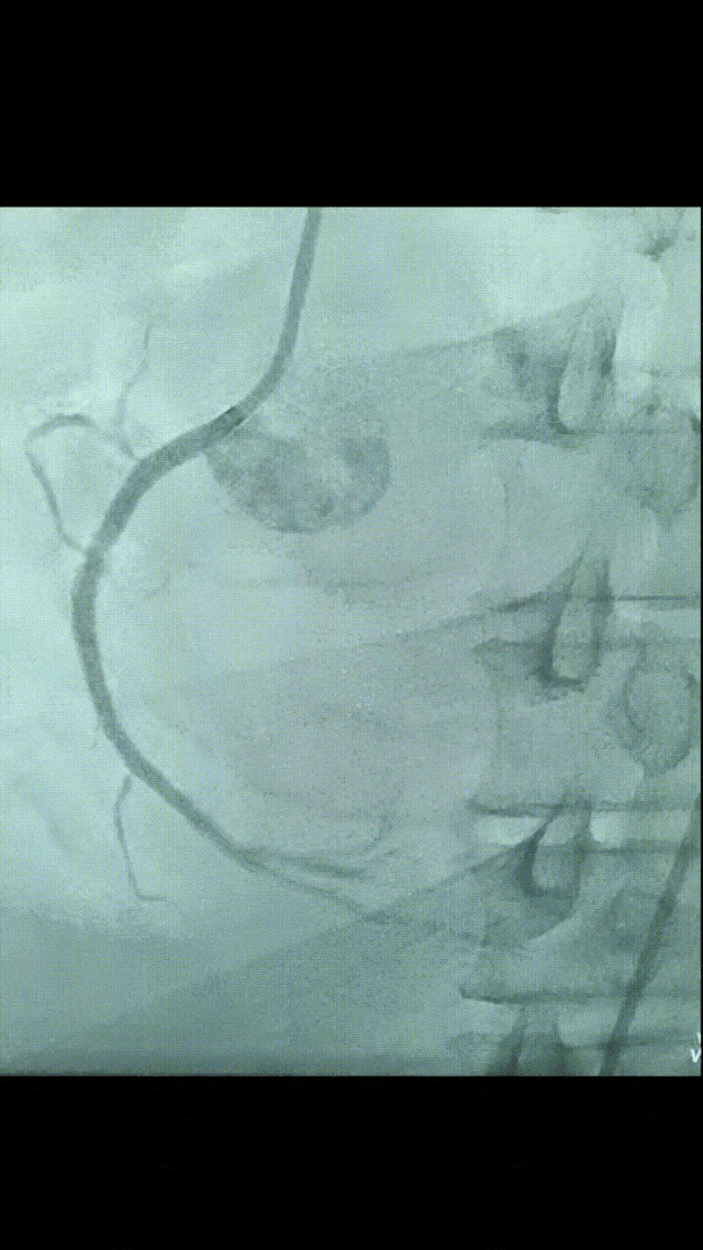 硬核护航，突破心脏手术禁区——ECMO 辅助攻克复杂高危 PCI 术难题