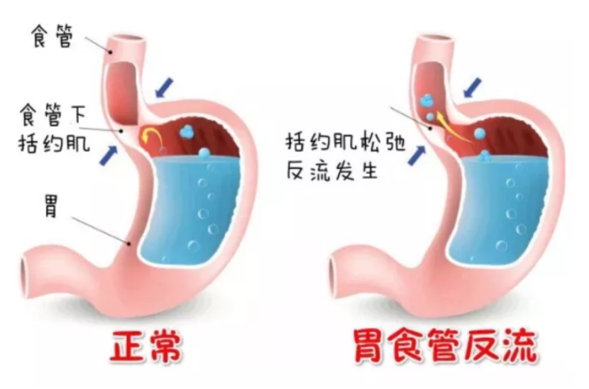 胃里反酸、胸口烧心?别硬扛!这份“抗反流”攻略请收好