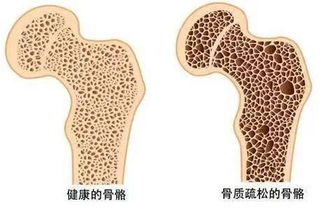 守护“骨”量 远离骨质疏松!