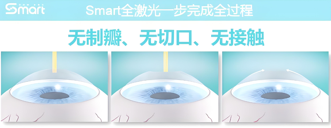 关于Smart全激光,你可能不知道的一些真相