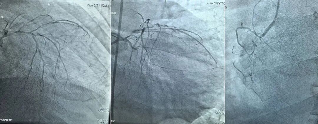 硬核护航，突破心脏手术禁区——ECMO 辅助攻克复杂高危 PCI 术难题