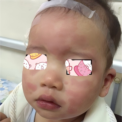 孩子满身“风疙瘩”别慌|儿童急性荨麻疹科普
