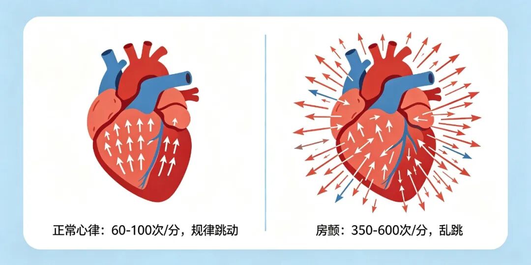 心律失常系列科普丨心跳"乱了节拍"?心内科医生带您读懂房颤
