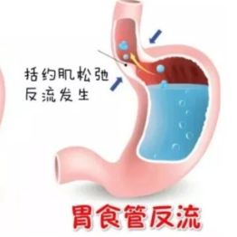 胃里反酸、胸口烧心？别硬扛！这份“抗反流”攻略请收好