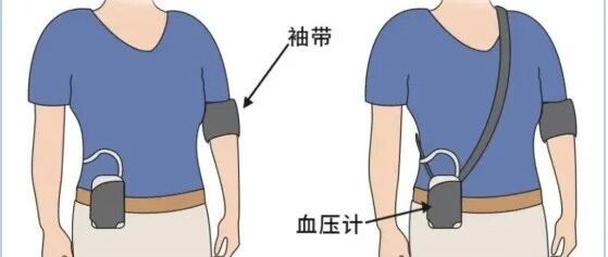 单次血压值不算数！24小时动态监测 才代表你的真实血压水平
