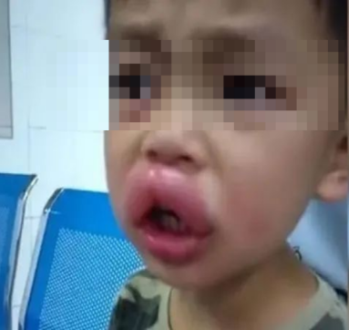 孩子满身“风疙瘩”别慌|儿童急性荨麻疹科普