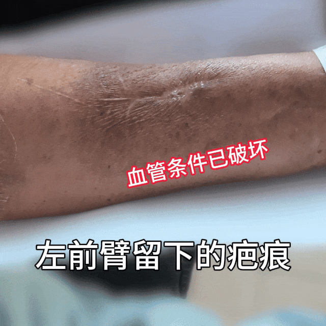 肾内医生通过吸脂术,让肾病患者造瘘有了新选择